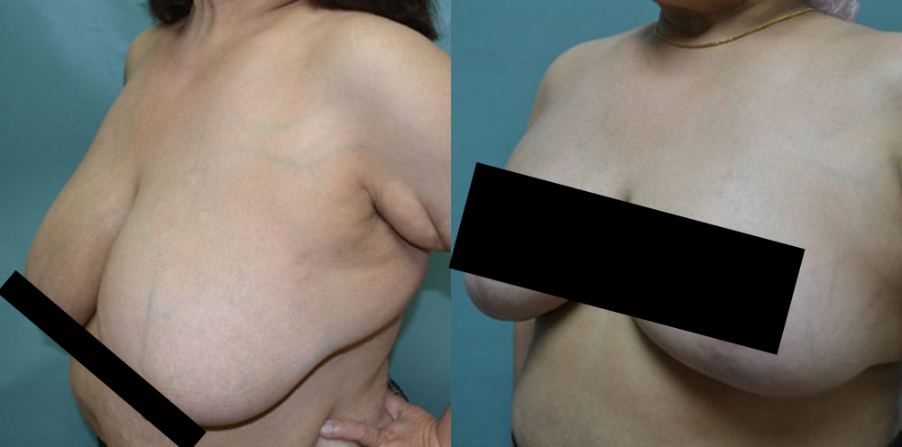 Breast Lift & Reduction Surgery