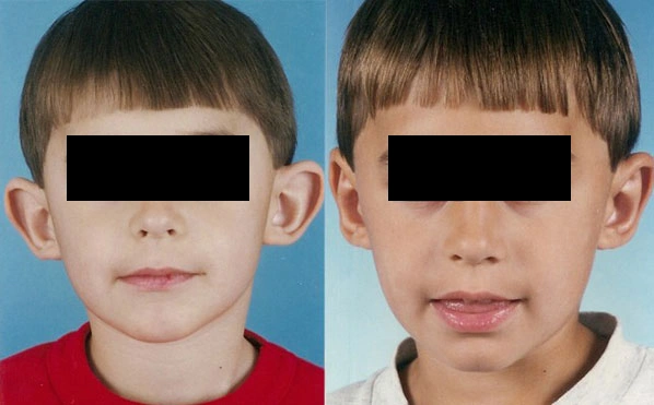 otoplasty-1