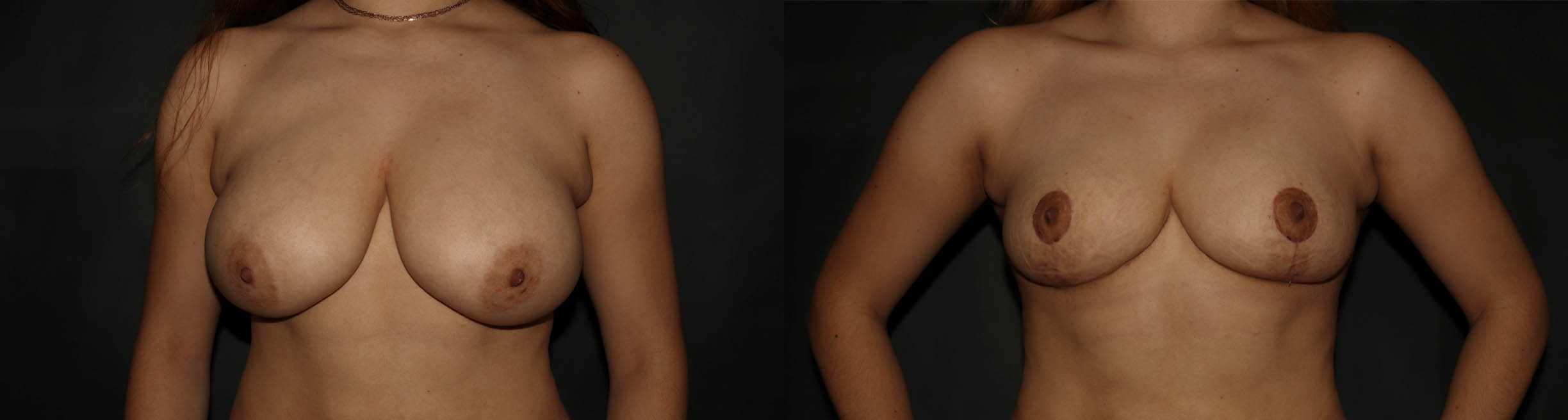 breast red (6)